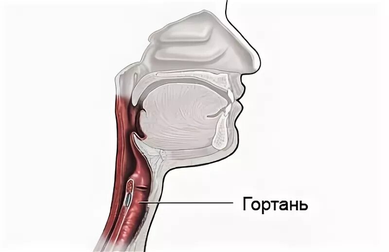 Дал в гортань. Носоглотка надгортанник. Хондроперихондрит гортани фото. Гортань вид сбоку.