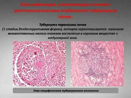 Туберкулезный папиллит