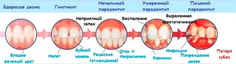 Язвенно некротический гингивит. Заболевания пародонта гингивит. Зубы болят и сверху и снизу