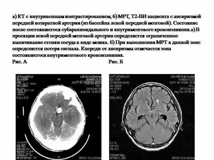 Что такое аневризма головного мозга простыми словами