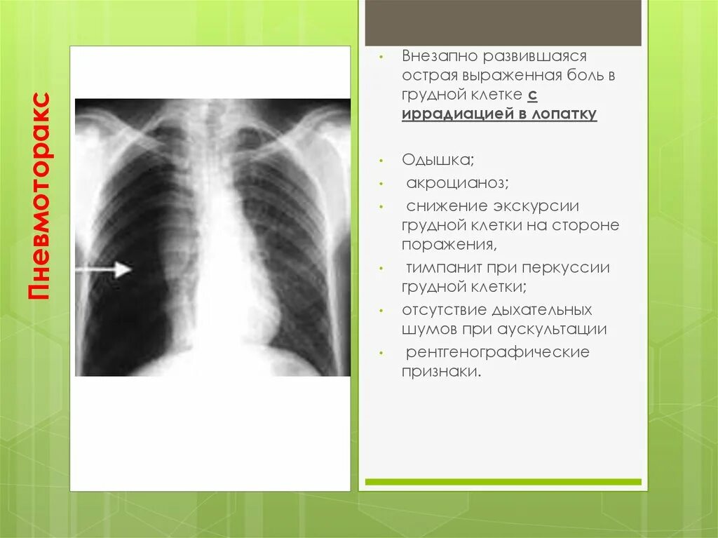 Ноющая боль в левом грудной клетки. Болит вверху грудной клетки. Болит справа в грудной клетке. Боли в области грудной клетк. Что если болит справа в грудной клетке.