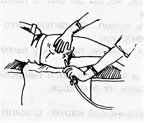 Очистительная клизма больно. Постановка очистительной клизмы. Очистительная клизма. Газоотводная трубка вводится в прямую кишку на глубину. Введение клизмы.
