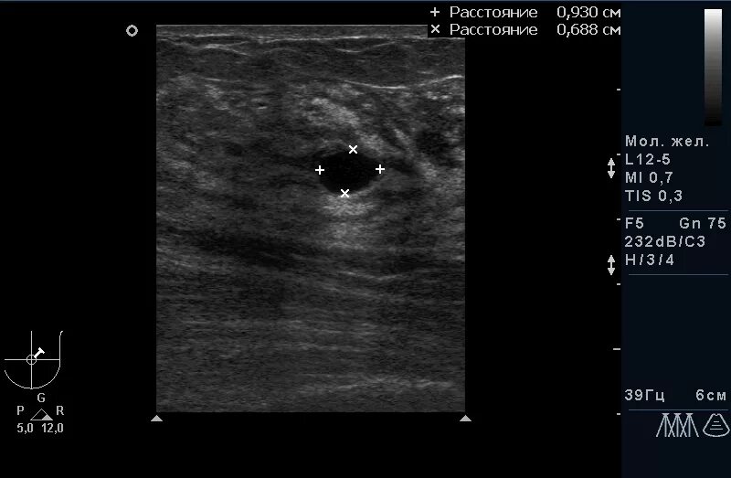 Записаться на узи молочной железы. Фиброзно кистозная мастопатия молочной железы УЗИ. Фиброзная мастопатия молочных желез на УЗИ. Диффузная фиброзно-кистозная мастопатия на УЗИ. УЗИ картина мастита молочной железы.
