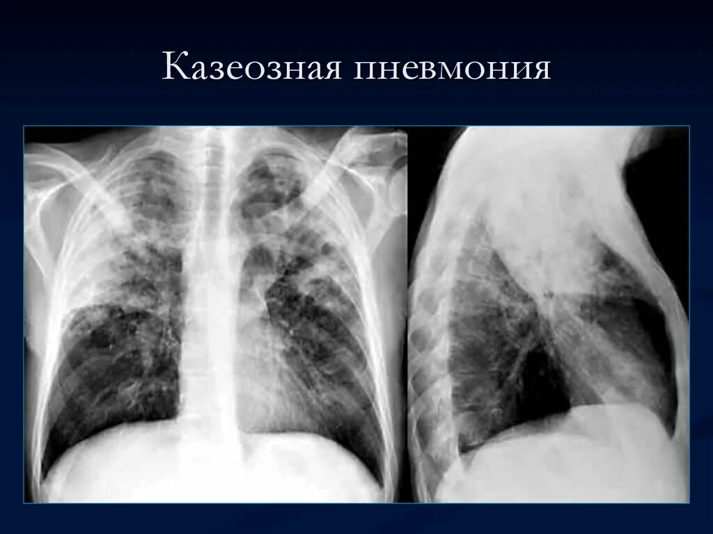 Казеозная пневмония рентген. Казеозная пневмония туберкулез легких рентген. Казеозная пневмония туберкулез рентген. Казеозная пневмония инфильтрат.