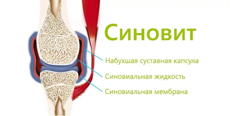 Синовиальная оболочка локтевого сустава. Синовит колена коленного сустава. Синовит локтевого сустава. Бурсит коленного сустава.