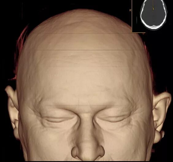 3д реконструкция кт черепа. Кт реконструкции головы. Череп реконструкция 3 д. Кт реконструкция