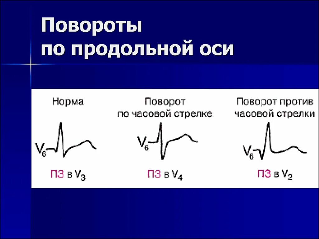 Повороты сердца на ЭКГ вокруг продольной оси. Поворот вокруг продольной оси ЭКГ. Поворот сердца против часовой стрелки на ЭКГ. Поворот сердца вокруг продольной оси против часовой стрелки на ЭКГ. Сердце против часовой стрелки