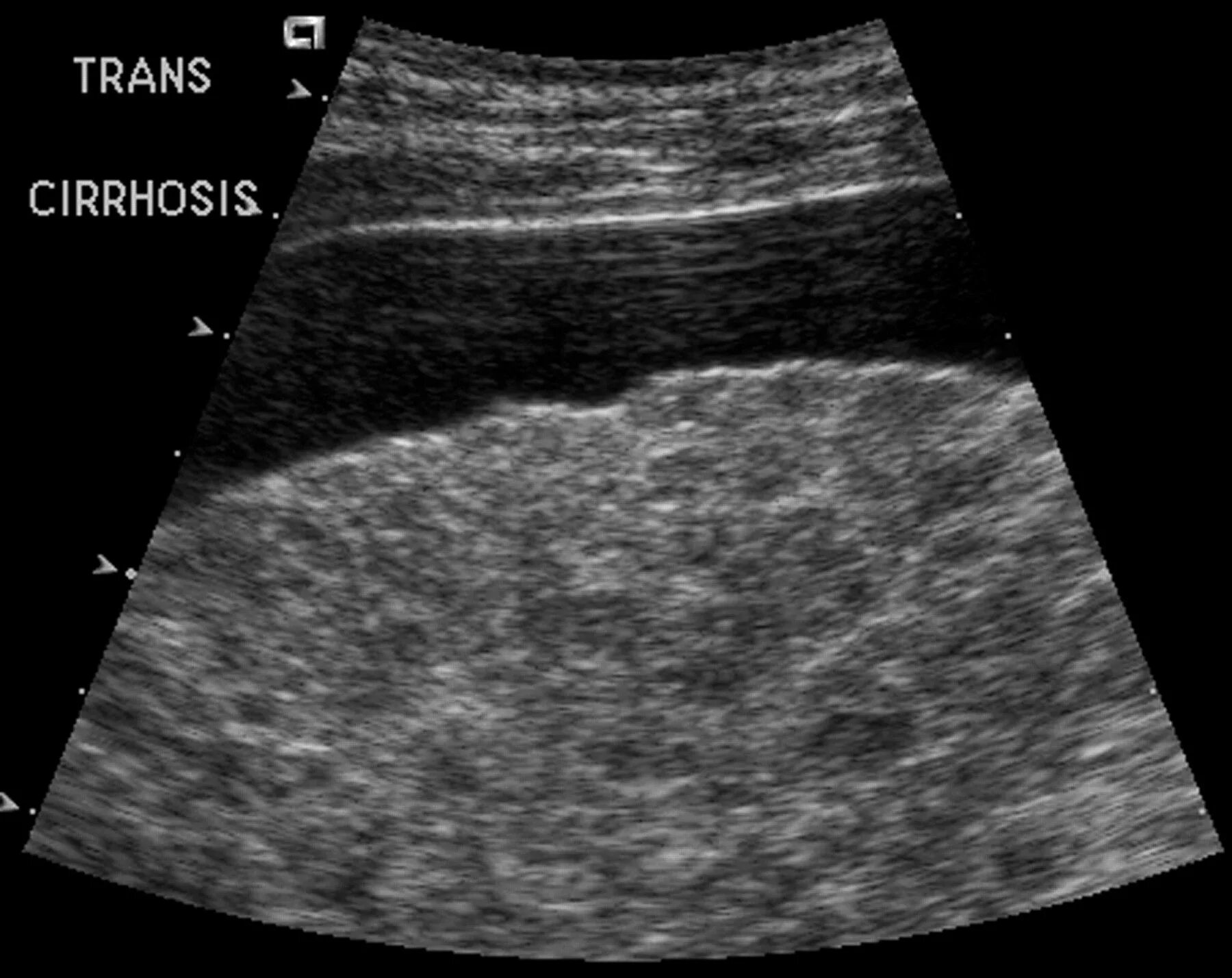 Узи печени собаки. Узлы регенерации печени при циррозе на УЗИ. Сонография желчного пузыря. Фиброз печени УЗИ картина.