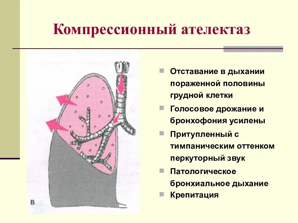 Спадение бронха