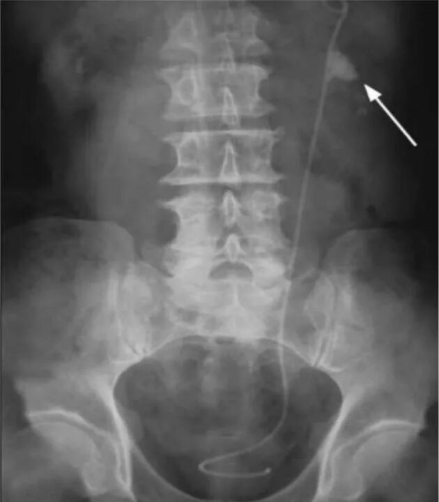 Перегиб мочеточника. Обзорная урография мочекаменная болезнь. Мочекаменная болезнь обзорная рентгенография. Мочекаменная болезнь экскреторная урография. Обзорная урография камень мочеточника.