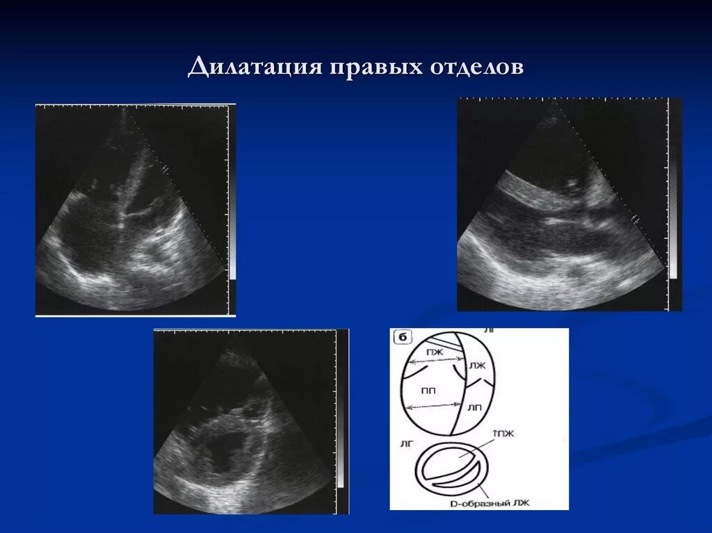 Дилатация правых отделов