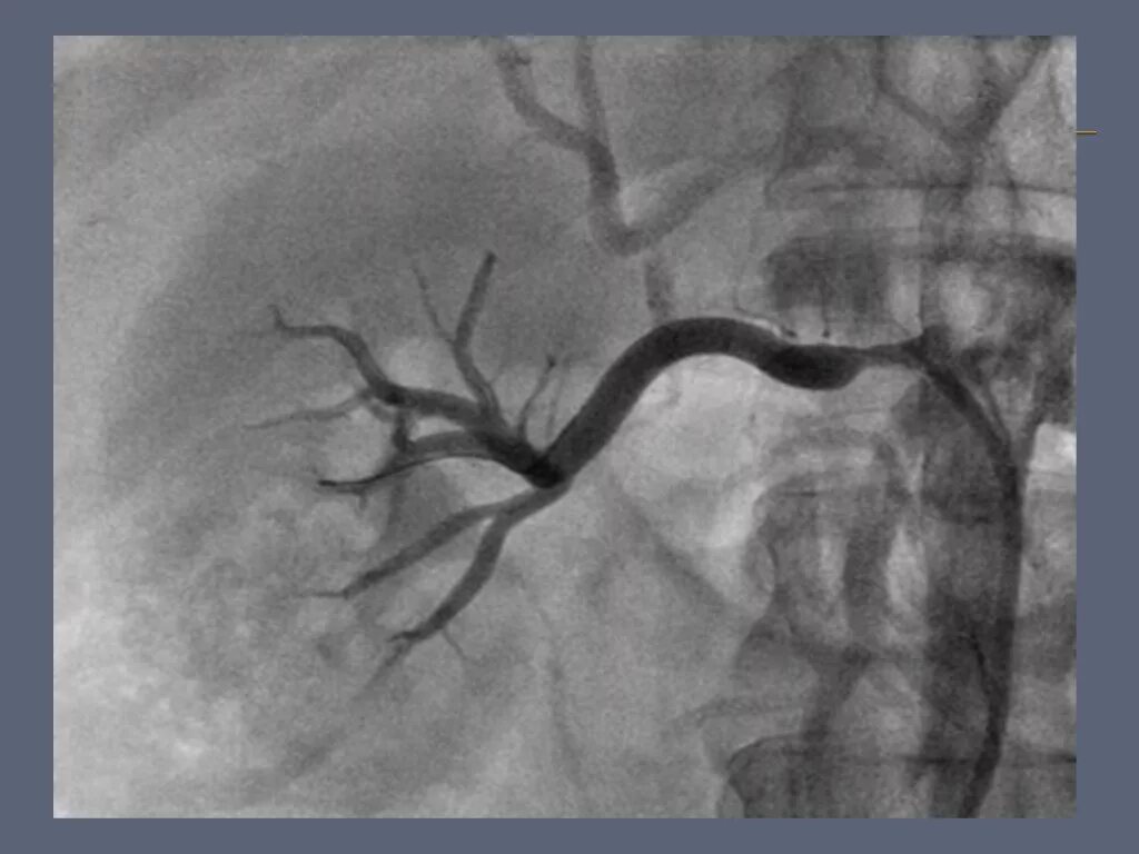 Тромбоз почечной вены кт. Фибромускулярный стеноз почечной артерии. Стеноз почечной артерии на рентгене. Атеросклероз почечных артерий. Уздг почечных артерий стеноз.