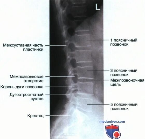 Рентгенография позвоночника в 2 х проекциях. Рентген поясничного отдела позвонка. Рентген пояснично-крестцового отдела. Рентгеновский снимок пояснично-крестцового отдела. Шейный отдел позвоночника рентген боковая проекция.