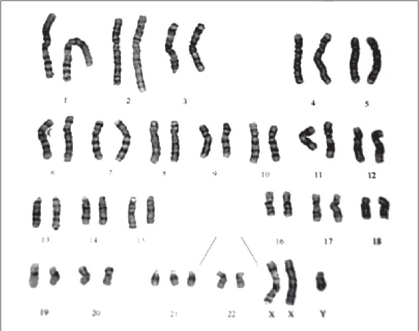 Хромосомы краба. Анеуплоидия XYY хромосом.