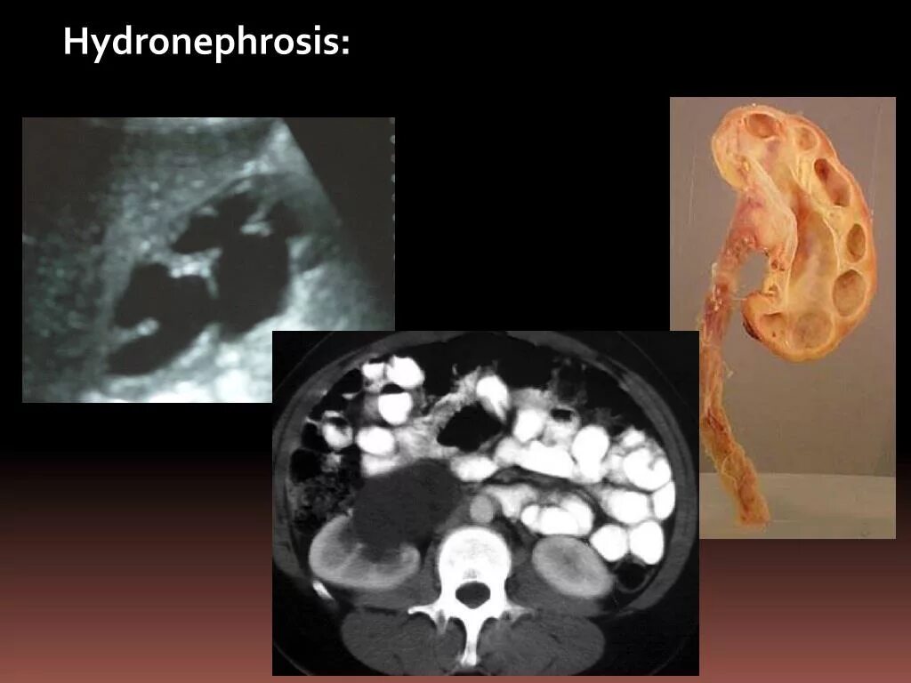 Заболевание почек гидронефроз. Гидронефроз макропрепарат. Гидронефроз почки макропрепарат. Калькулезный гидронефроз.