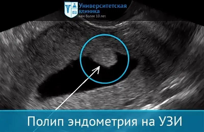 Плацентарный полип патоморфология. Полипэктомия полипа эндометрия. Полипэктомия эндометрия. Полипоз эндометрия отзывы. Лекарства от полипа эндометрия.