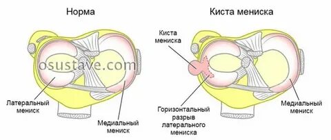 Сколько восстановление после операции на мениск