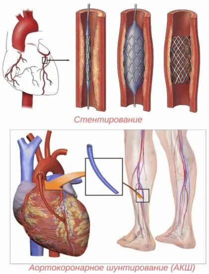 Коронарное шунтирование сосудов сердца. Операция стентирование сосудов сердца. Аортокоронарное шунтирование операция. Шунтирование и стентирование. Как делают коронарное шунтирование