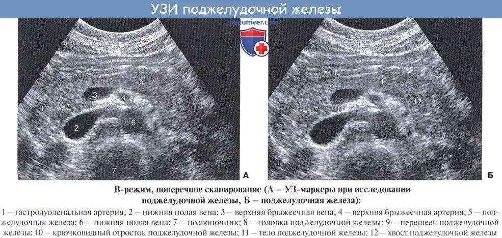 Гиперэхогенное образование поджелудочной железы УЗИ. Ультрасонография поджелудочной железы. Эхограмма поджелудочной железы. Кальцинаты поджелудочной железы УЗИ. Поджелудочная маркеры