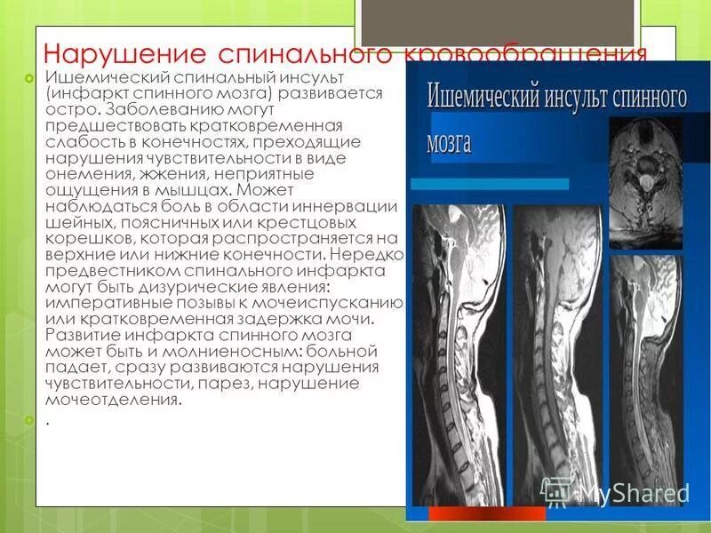 Спинальный инсульт что это симптомы и лечение. Ишемический инсульт спинного мозга. Нарушение чувствительности при спинальном инсульте. При спинальных инсультах наблюдаются расстройства чувствительности.