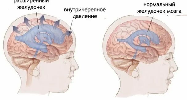 Как снизить внутричерепное давление головы у женщин. Внутричерепное давление рисунок. точки от внутричерепного давления. массаж при внутричерепном давлении. кофе и внутричерепное давление.
