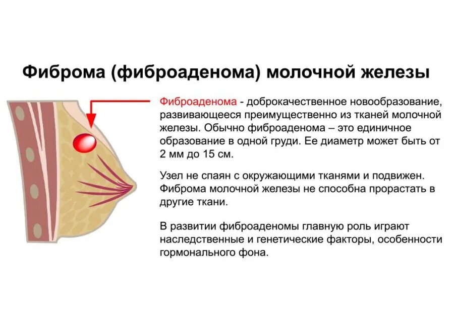 Фиброма в груди. Фиброаденома молочной же. Уплотнение в заушной железе. Уплотнения в молочных железах. Фиброаденома в молочной железе.