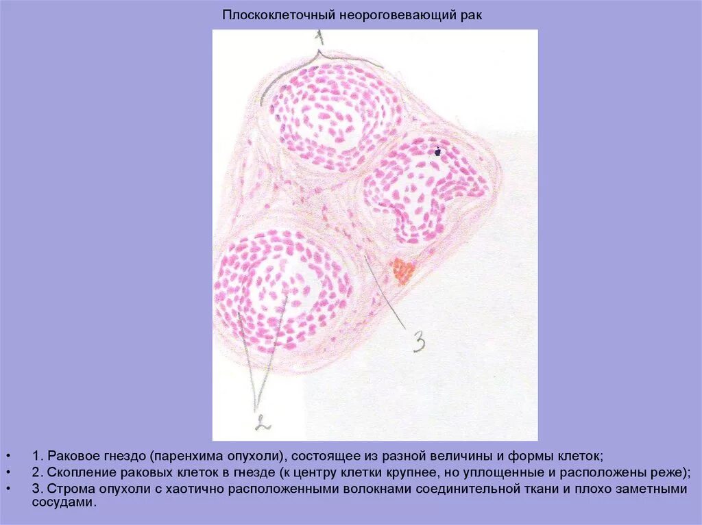 Плоскоклеточными опухолями. Плоскоклеточная неороговевающая карцинома. Паренхима и Строма опухоли. Плоскоклеточная опухоль.
