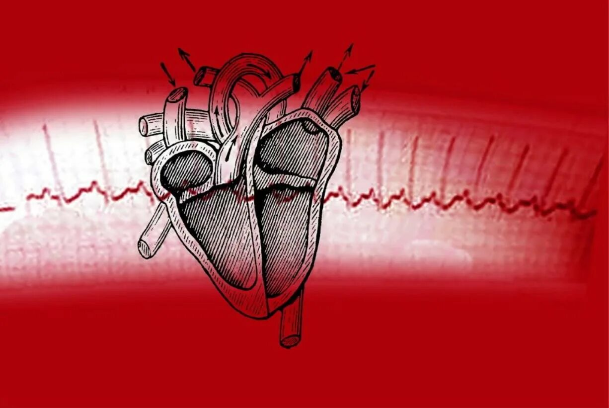 Хамиль остановка сердца. Сердце остановилось. Остановка сердца картинки. Смерть на ЭКГ.