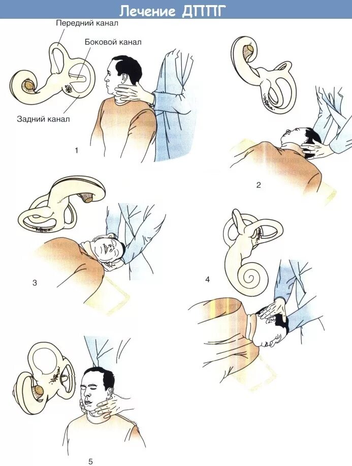 Доброкачественное позиционное головокружение. Лечебный позиционный маневр Эпли. Маневры Эпли при головокружении. Пароксизмальное позиционное головокружение упражнение.