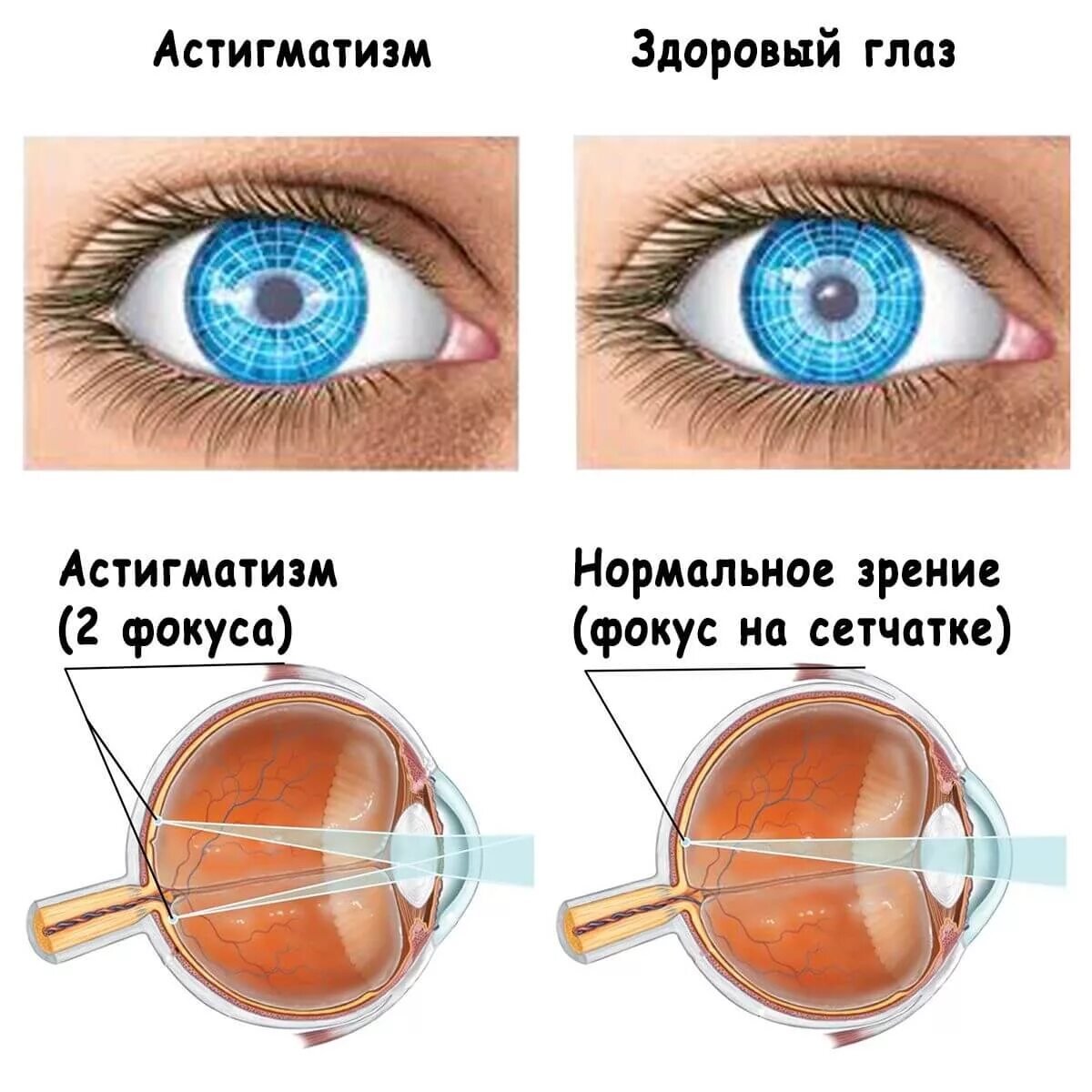 Пропадает зрение на одном глазу. Линзы астигматизм -2. Сложный гиперметропический астигматизм. Астигматизм 6 диоптрий. Сложный гиперметропический астигматизм у детей.