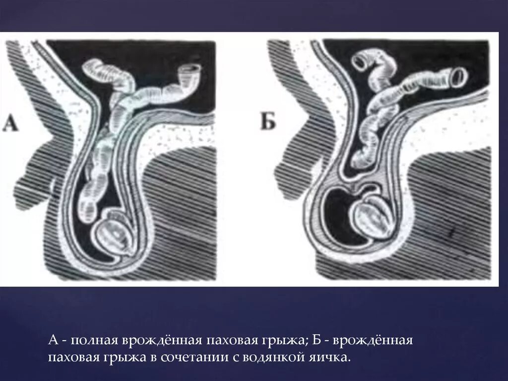 Канатиковая паховая грыжа. Канатиковая грыжа мошоночная. Пахово мошоночная грыжа ход операции. Пахово-мошоночная грыжа на кт. Паховая грыжа методы лечения