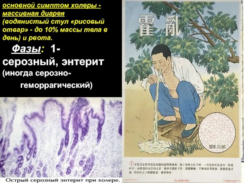 Стул рисовый отвар при холере. Клиника холеры инкубационный период. Холера 4 степень обезвоживания. Стул при холере. Стул при холере.