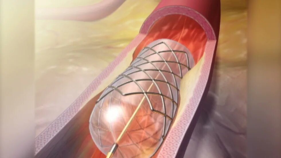 Стентирование видео. Мочеточниковые стентирование. Стентирование сосудов мочеточника.