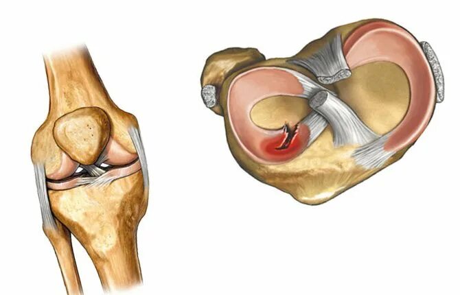Разрыв мениска коленного сустава. Разрыв медиального мениска коленного сустава. Мениски коленного сустава анатомия разрыв.