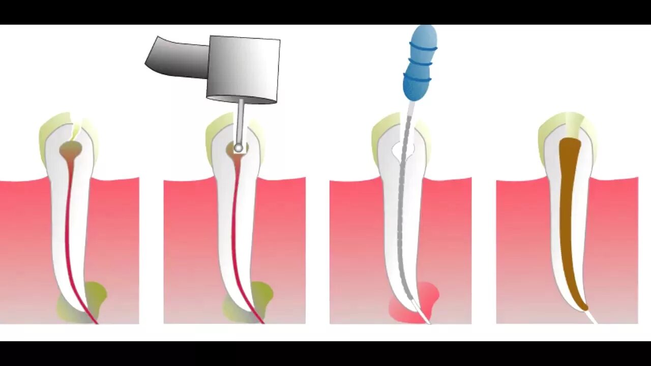 Пульпит корневого канала. Гангренозный пульпит зуба. Пломбирование корневых каналов. Термофил пломбировка каналов. Пломбирование зуба после лечения каналов