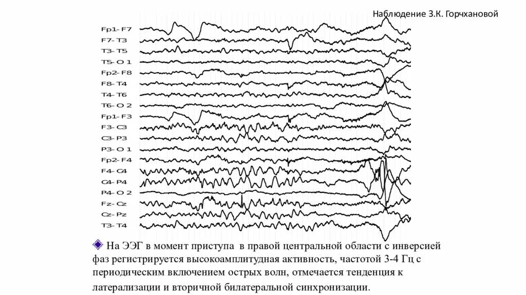 ЭЭГ головного мозга больного эпилепсией. ЭЭГ эпилепсия расшифровка. ЭЭГ здорового человека и эпилептика. ЭЭГ при эпилептическом статусе. Как выглядит ээг