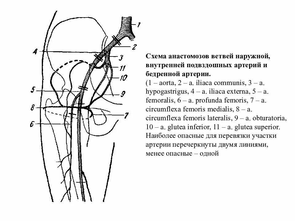 Бедренная перевязка. Схема магистральных артерий нижней конечности. Показания к перевязке подколенной артерии. Перевязка бедренной артерии. Перевязка артерии нижних конечностей.