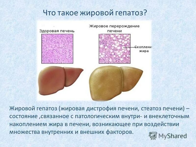 Дегенерация печени к 76.0. Жирового гепатоза печени. Жировой гепатоз печени симптомы. Жировая дистрофия печени(жировой гепатоз). Тиреотоксический гепатоз.