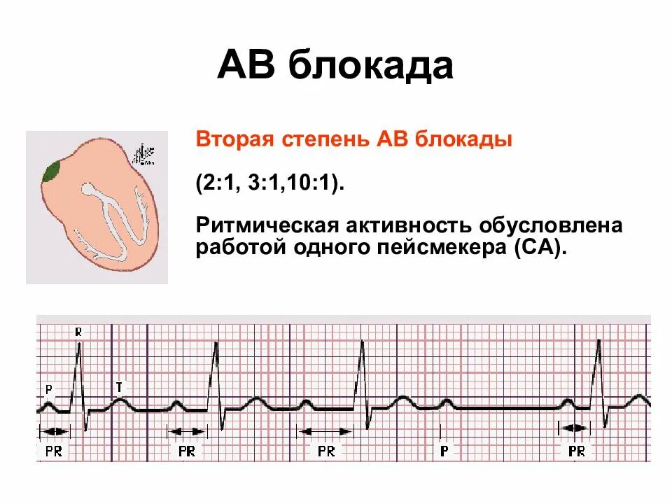 Системами блокада. АВ блокада 2 степени с периодикой 2 1. АВ блокада 1 степени Холтер. Атриовентрикулярная блокада i степени. Av блокада 2 степени с проведением 2:1.