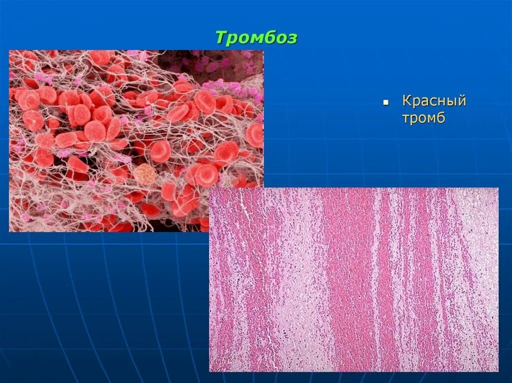 Белый красный смешанный гиалиновый тромб. Гиалиновый тромб микропрепарат. Фибриновый тромб гистология. Смешанный тромб строение. Тромб микропрепарат
