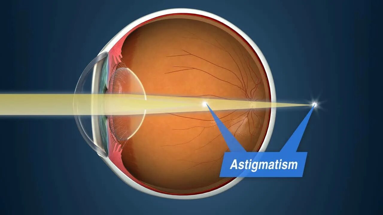 Сложный гиперметропический астигматизм. Астигматизм аберрация лечение. Астигматизм гиперметропический и гиперметропический. Аберрации оптических систем кома астигматизм. Астигматизм аберрация лечение.