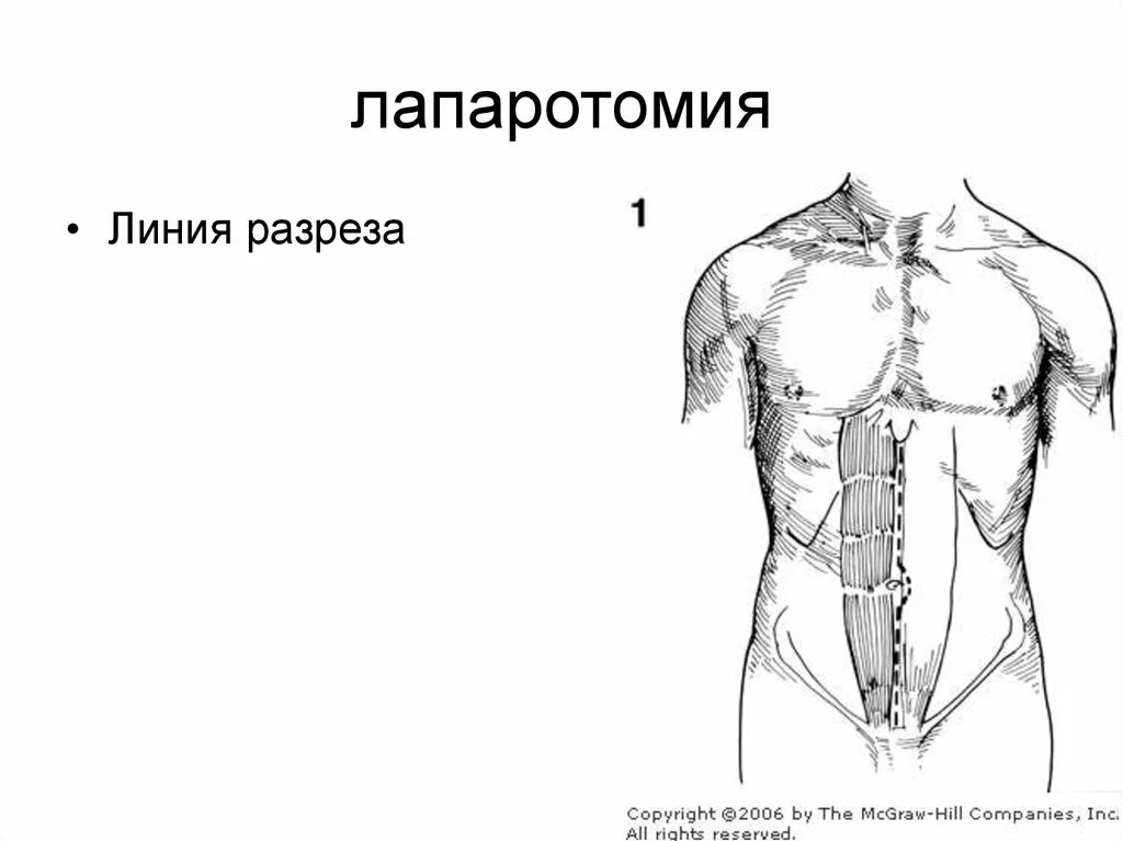 Лапаротомия. Срединная лапаротомия; параректальная лапаротомия.. нижне-средне-срединная лапаротомия. продольные разрезы лапаротомия. срединная лапаротомия схема.