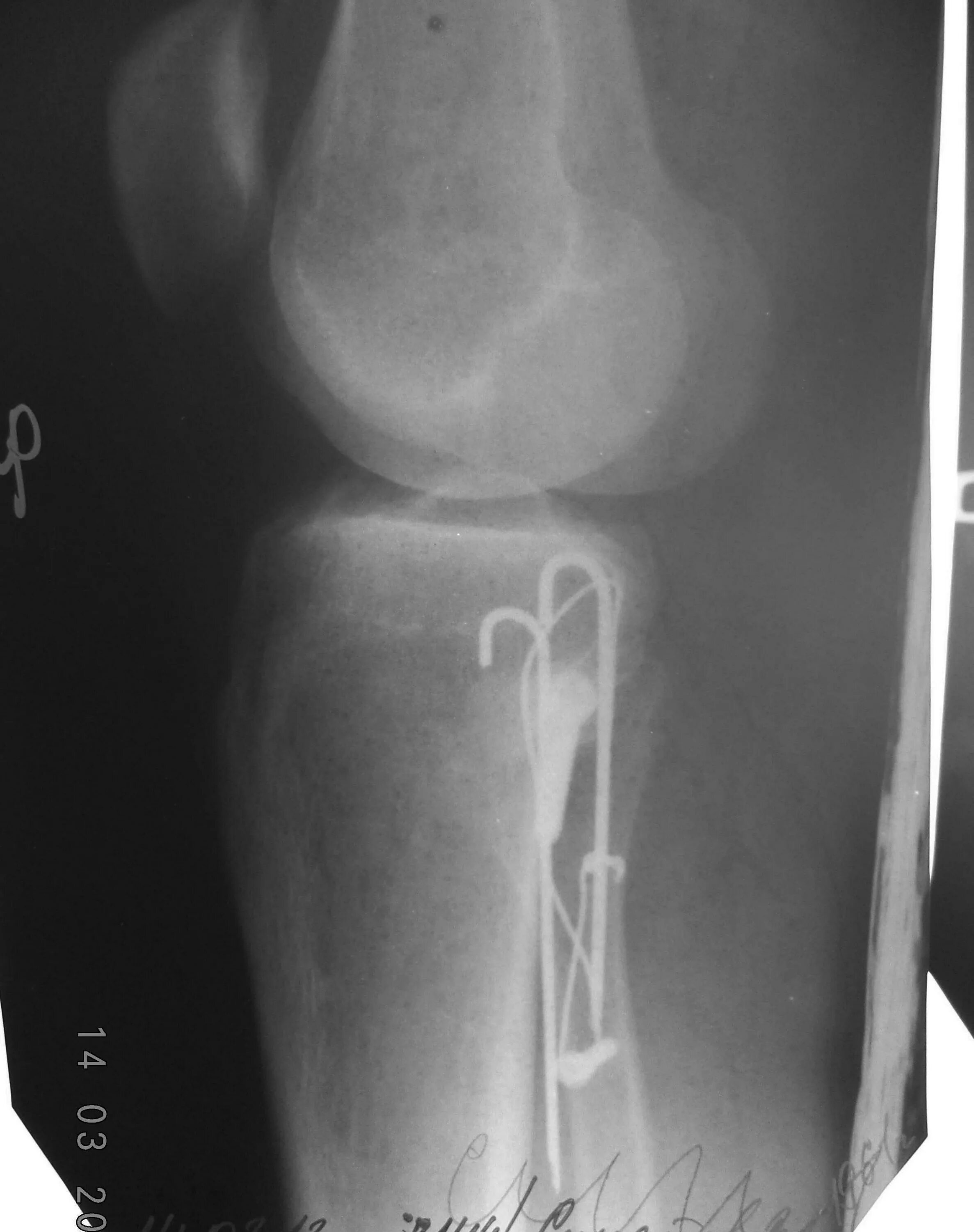 перелом голени и малоберцовой кости. перелом голени и малоберцовой кости. малоберцовая кость с лодыжкой перелом. разрыв дистального межберцового синдесмоза. перелом малоберцовой кости рентген.