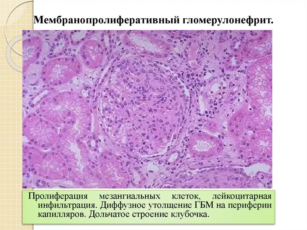 Мембранозно пролиферативный гломерулонефрит. Мембранозный гломерулонефрит патанатомия. Мезангиокапиллярный гломерулонефрит гистология. Серозный гломерулонефрит патанатомия. Хронический диффузный гломерулонефрит