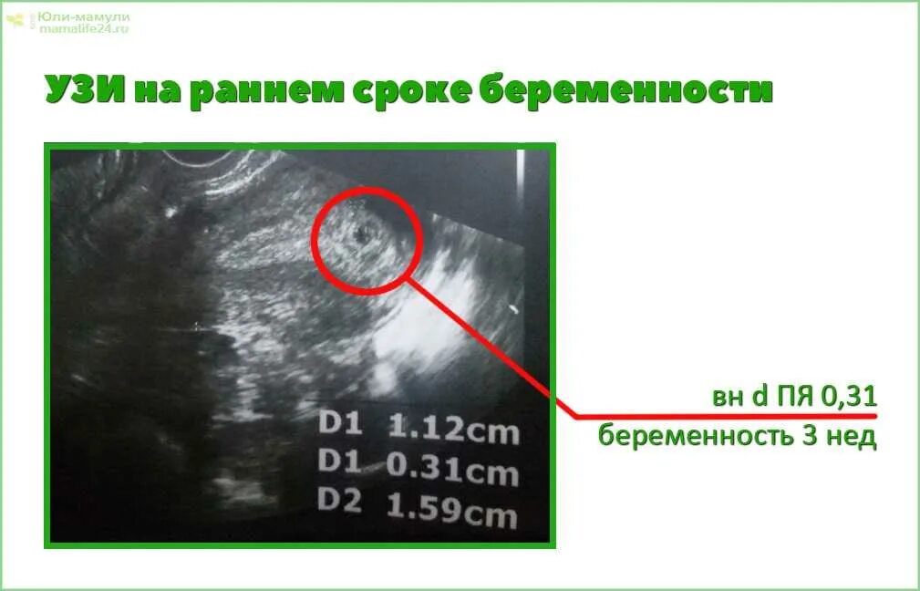 Какое узи делают на раннем сроке беременности. УЗИ беременности на ранних. УЗИ на первых сроках беременности.