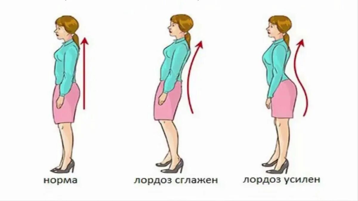 Усиленный лордоз. Поясничный лордоз сглажен. Сглажен лордоз в поясничном отделе позвоночника. Физиологический лордоз сглажен поясничного отдела. Сглаживание лордоза поясничного отдела позвоночника.