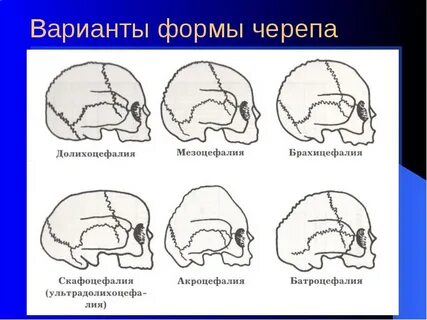 Брахиоцефалия