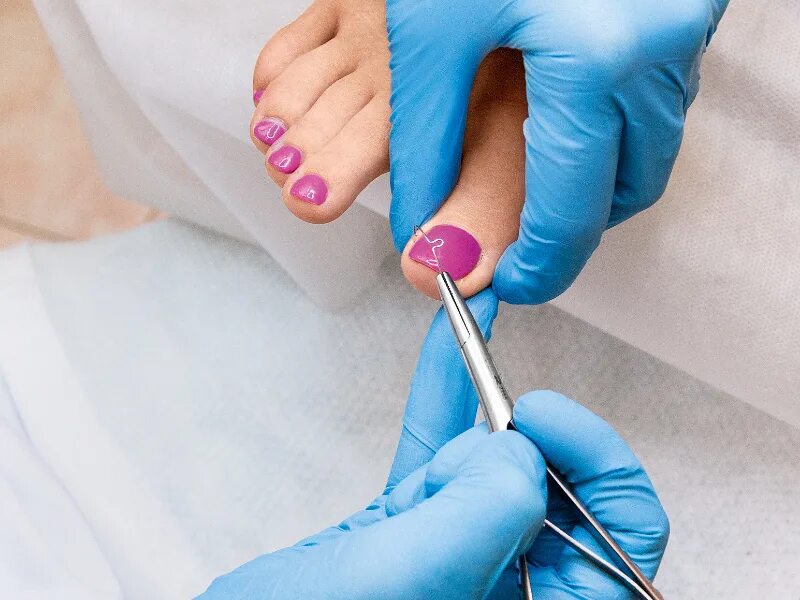 Скоба 3то корректирующая. Подолог удаляет ноготь. Подологический педикюр. Подолог удаляет ноготь. Подологический педикюр.