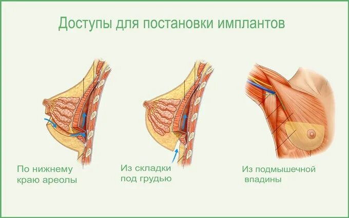 Липофилинг молочных желез по доступной цены в Минске