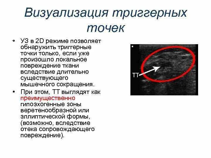 Как найти триггерную точку